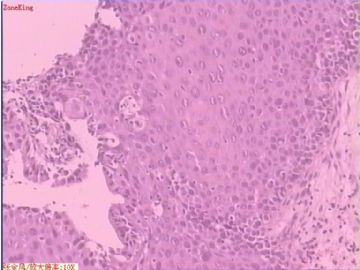 宫颈活检组织图9