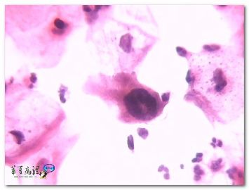 宫颈液基．４０岁．临床提示ＨＳＶ感染．图1