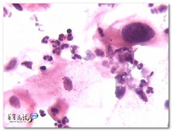 宫颈液基．４０岁．临床提示ＨＳＶ感染．图2
