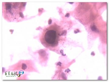 宫颈液基．４０岁．临床提示ＨＳＶ感染．图3
