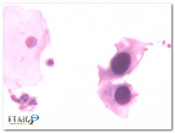宫颈液基．４０岁．临床提示ＨＳＶ感染．图4