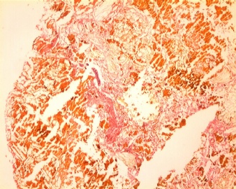 胆囊壁、胆结石（大体：图1）；胆结石图2