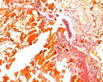 胆囊壁、胆结石（大体：图1）；胆结石图3