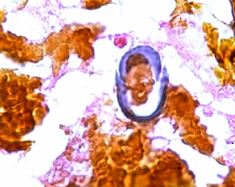 胆囊壁、胆结石（大体：图1）；胆结石图8