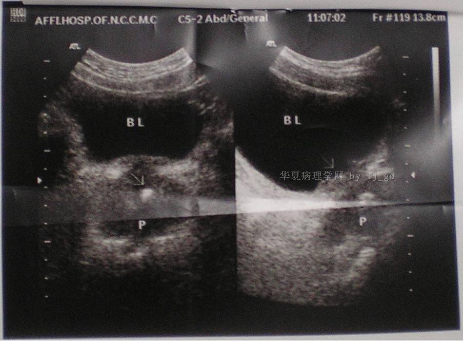 膀胱颈肿物_请各位老师指教图2