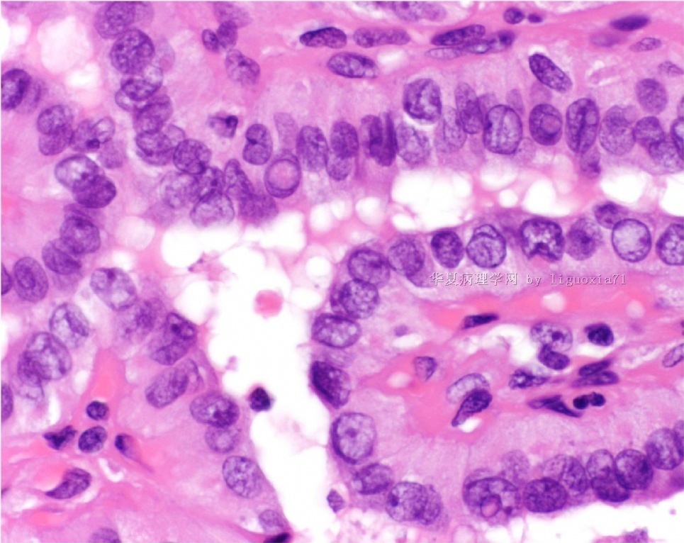 请看甲状腺乳头状癌中的核内包涵体和核沟图1