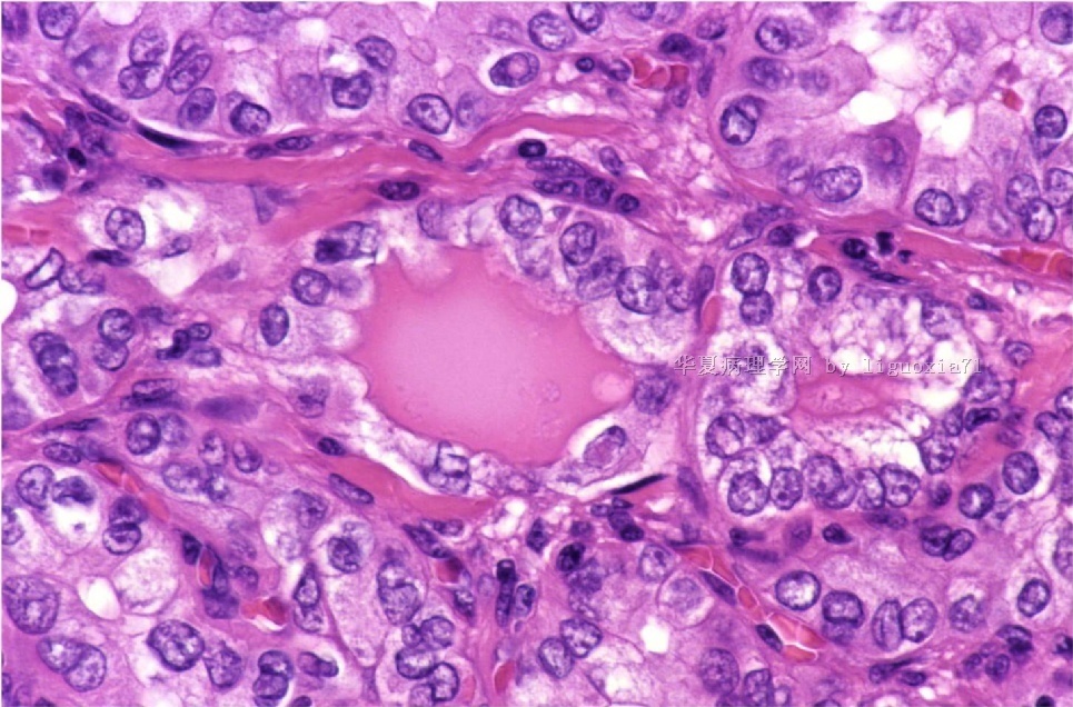 请看甲状腺乳头状癌中的核内包涵体和核沟图2