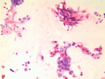 38岁，宫颈液基，H-E染色。图1