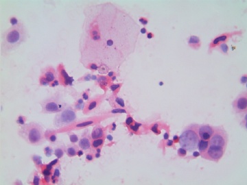 38岁，宫颈液基，H-E染色。图5