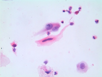 38岁，宫颈液基，H-E染色。图14