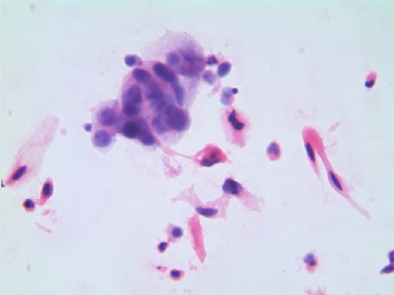 38岁，宫颈液基，H-E染色。图17