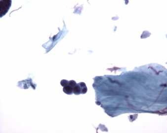 来自cytologystuf网站中文版的一个病例。图1