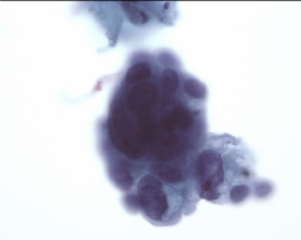 来自cytologystuf网站中文版的一个病例。图2