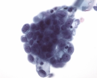 来自cytologystuf网站中文版的一个病例。图3