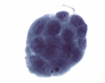 来自cytologystuf网站中文版的一个病例。图4