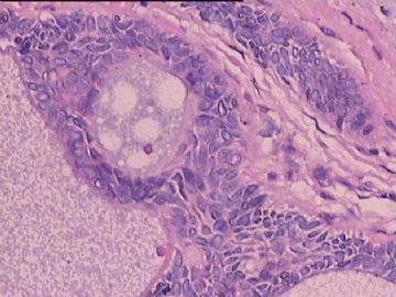 会诊后两种意见:皮肤附属器源性肿瘤;基底细胞癌图9