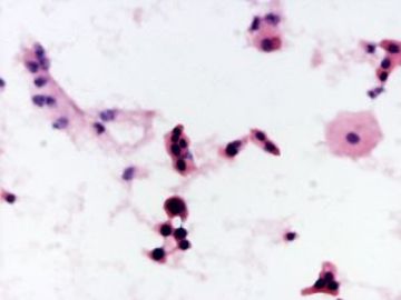 59岁，绝经5年-有组织学结果图3