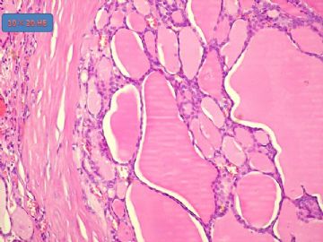 甲状腺结节。图10