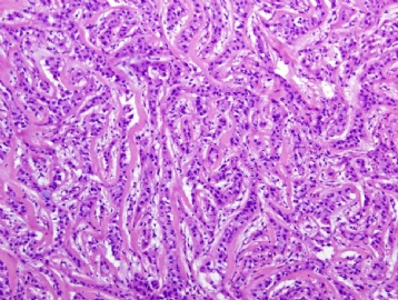 35 Year old with testicular nodule图2