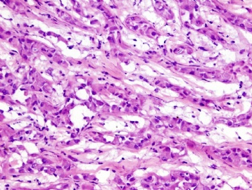 35 Year old with testicular nodule图3