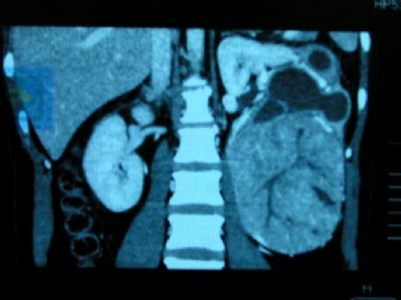 左肾未见过的肿瘤图7