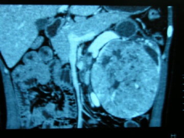 左肾未见过的肿瘤图8