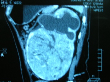 左肾未见过的肿瘤图9