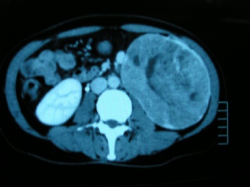 左肾未见过的肿瘤图10