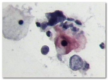 宫颈液基．３０岁．ＨＰＶ６，１１，１６，１８ＤＮＡ阴性图2