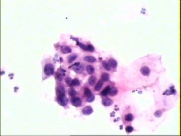 宫颈TCT-1687(上传8个月后的宫颈活检组织学图像)图3