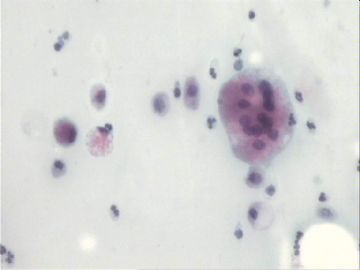 宫颈刮片．７２宫颈赘生物三个有蒂，黄带腥臭一年．图6