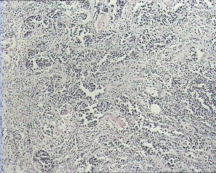 乳腺肿瘤周边间质弥漫性淋巴细胞浸润图1