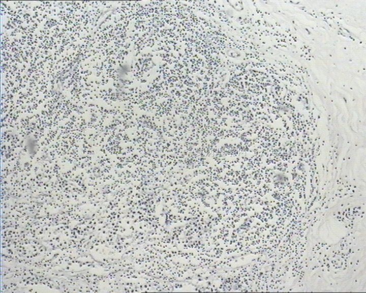 乳腺肿瘤周边间质弥漫性淋巴细胞浸润图2