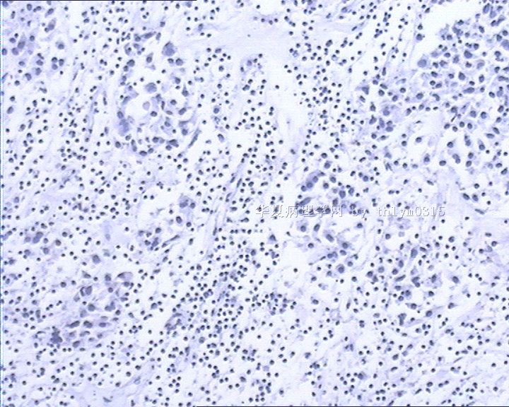 乳腺肿瘤周边间质弥漫性淋巴细胞浸润图5