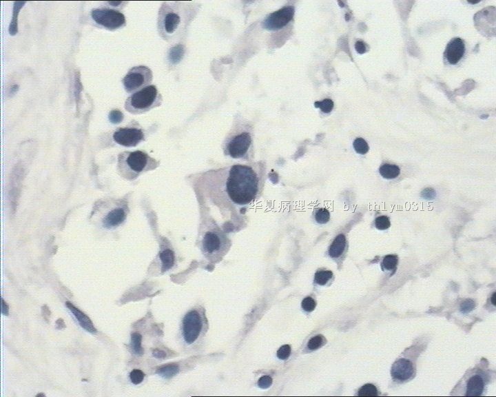 乳腺肿瘤周边间质弥漫性淋巴细胞浸润图7