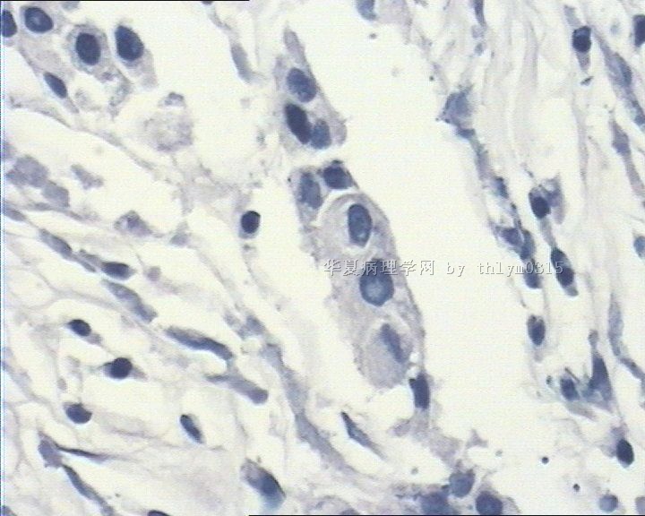 乳腺肿瘤周边间质弥漫性淋巴细胞浸润图8