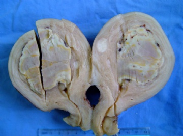 子宫平滑肌肿瘤图1