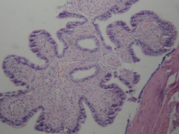输卵管囊泡图1