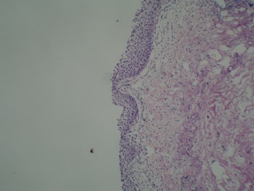 膀胱新生物图1