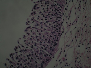 膀胱新生物图2