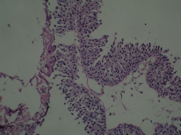 膀胱新生物图6