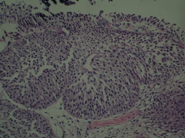 膀胱新生物图7