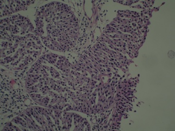 膀胱新生物图9
