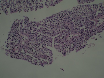 膀胱新生物图10
