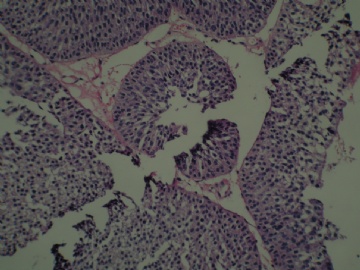 膀胱新生物图11