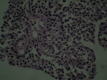 膀胱新生物图12