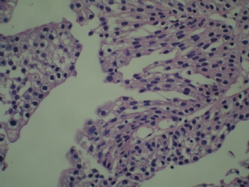 膀胱新生物图15