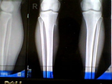 胫骨肿物，请求会诊图3