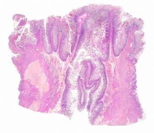 来自法国的疑难病例 “蜕膜样恶性间皮瘤”图3