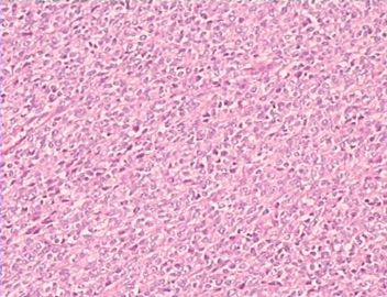 大网膜肿瘤（附免疫组化），请发表意见！图4